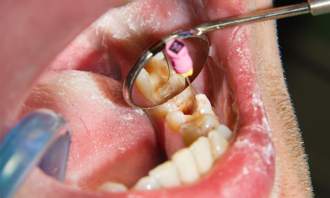 What Are the Risks of Avoiding a Root Canal?