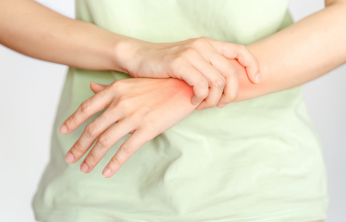 Psoriatic Arthritis