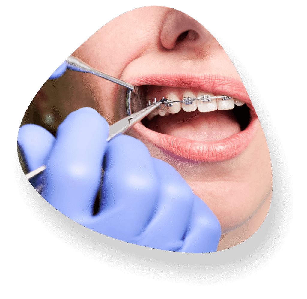 Orthodontic Treatment