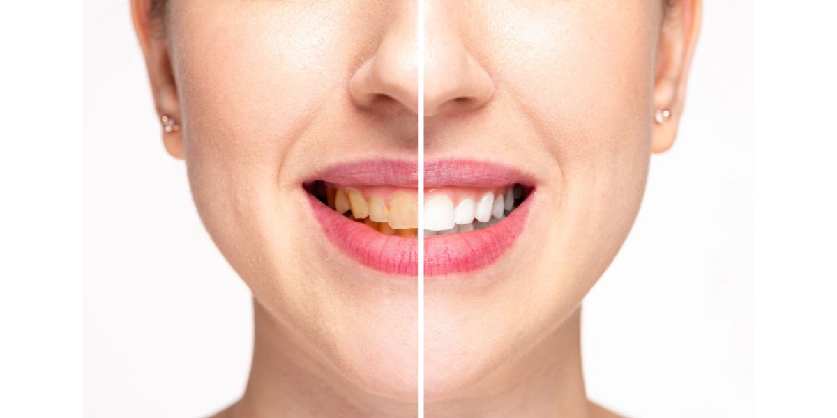 Teeth Whitening Hounslow