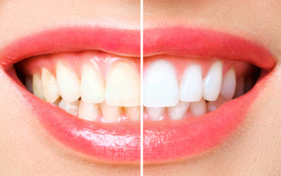 Thinking About Teeth Whitening in Carrum Downs? Here’s What You Should Know