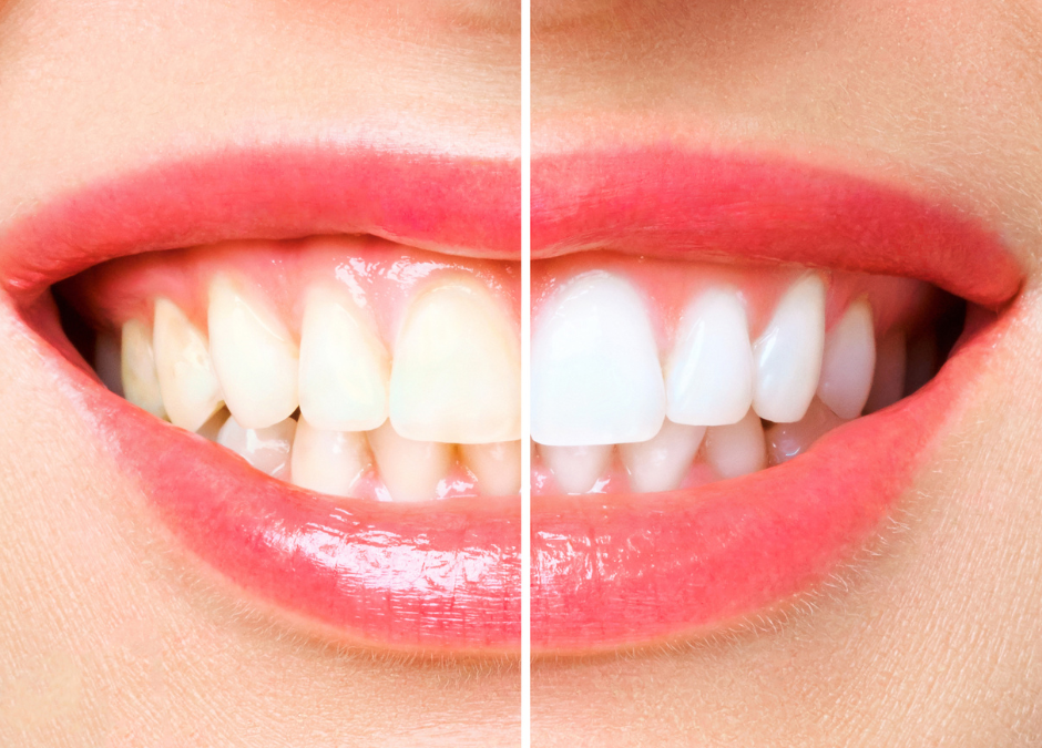teeth whitening Carrum Downs