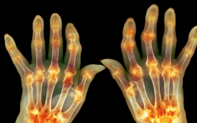  How Rheumatologists Diagnose Rheumatoid Arthritis and Other Inflammatory Conditions