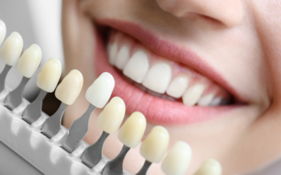 The Truth About Teeth Whitening: What Works, What Doesn’t and What to Expect