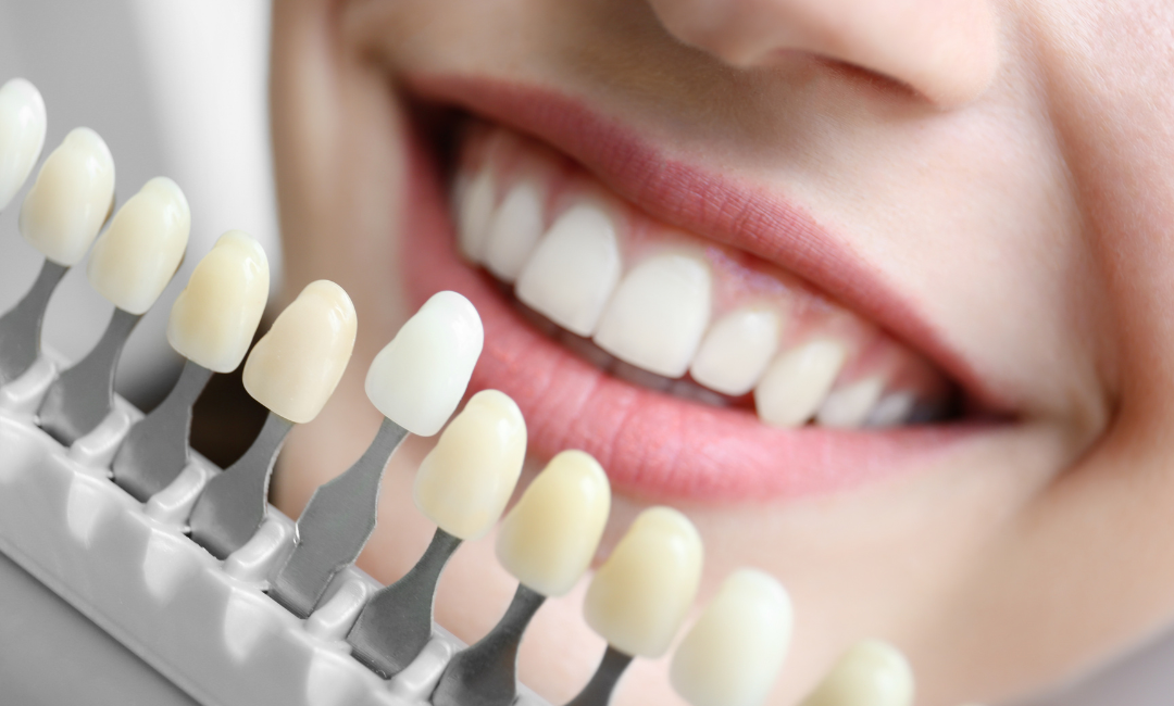 Teeth Whitening Penrith